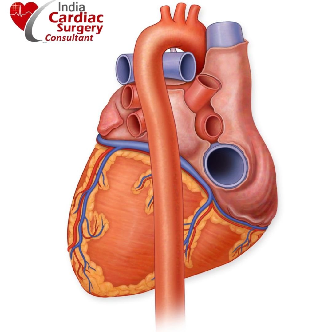 Coût de la procédure endovasculaire pour le traitement des anévrismes en Inde